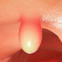 Polyp