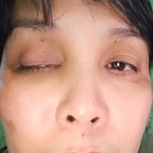 Sụp mí mắt