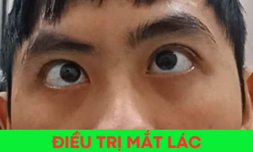 Điều trị Mắt lác