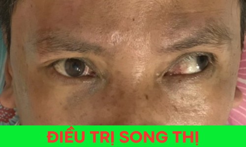 Điều trị Song thị