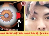Mắt lác ngoài - Tất tần tật những điều cần biết