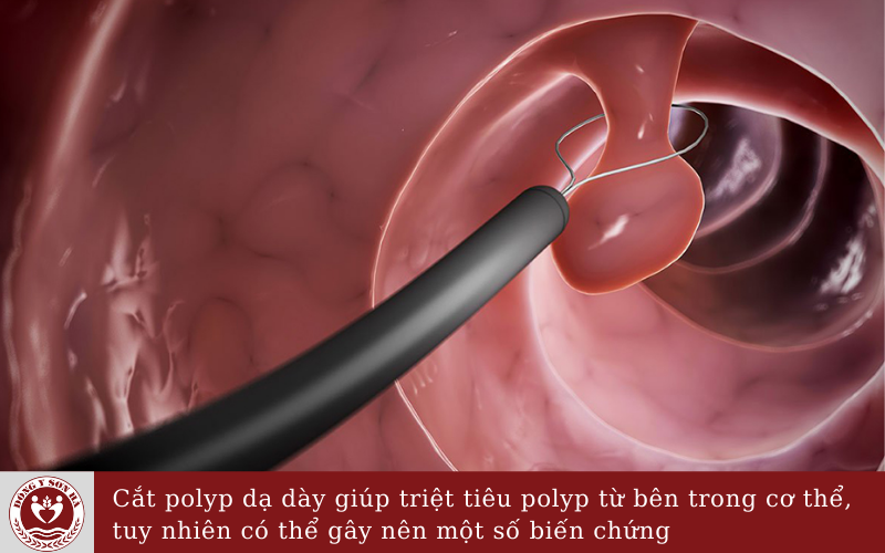 Có nên cắt polyp dạ dày không? 